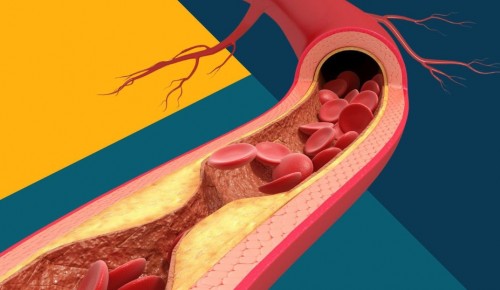 В больнице имени Виноградова рассказали о формировании холестериновых бляшек в сонных артериях