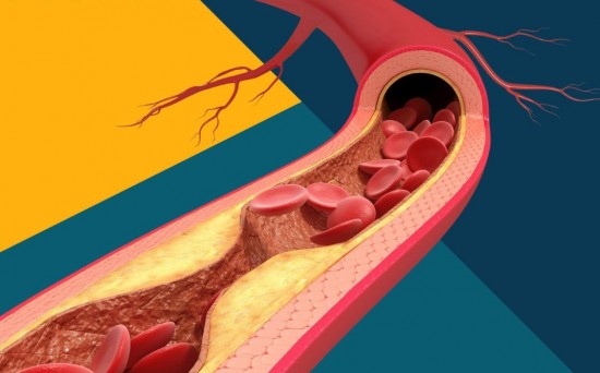 В больнице имени Виноградова рассказали о формировании холестериновых бляшек в сонных артериях