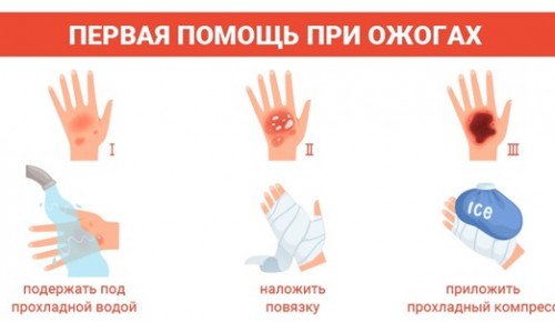 Специалисты рассказали, как помочь человеку с термическими ожогами