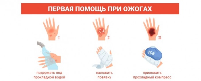 Специалисты рассказали, как помочь человеку с термическими ожогами